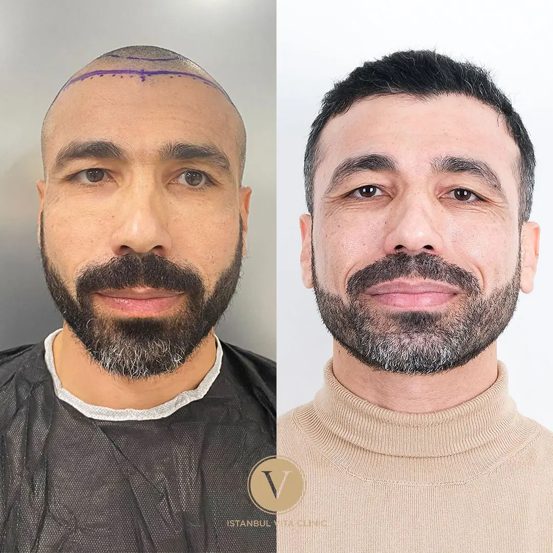 Hair Transplant Turkey